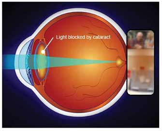cataract view