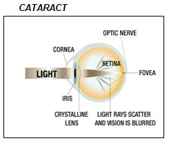 Cataract
